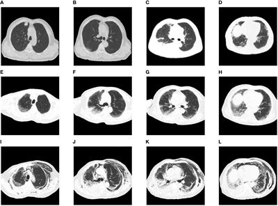 Case report: Checkpoint inhibitor pneumonitis with positive anti-melanoma differentiation-associated gene 5 antibodies in a patient with lung cancer